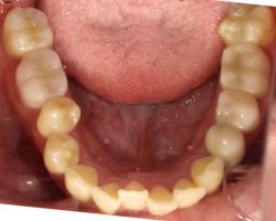 fuchu-invisalign-case1-before2