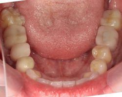 fuchu-invisalign-case1-after2