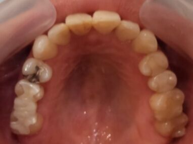 fuchu-invisalign-case2-after2