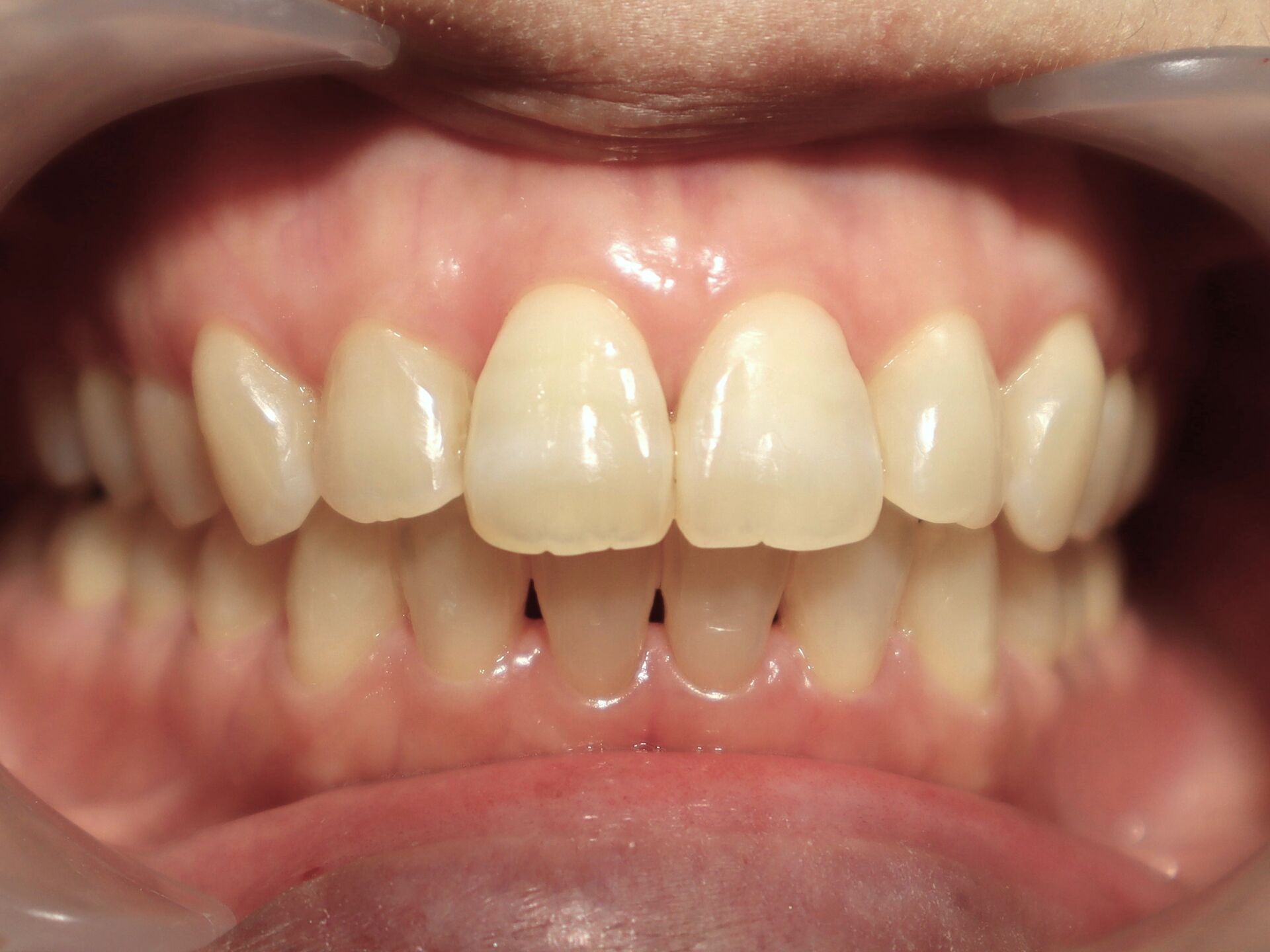 fuchu-invisalign-case3-after1