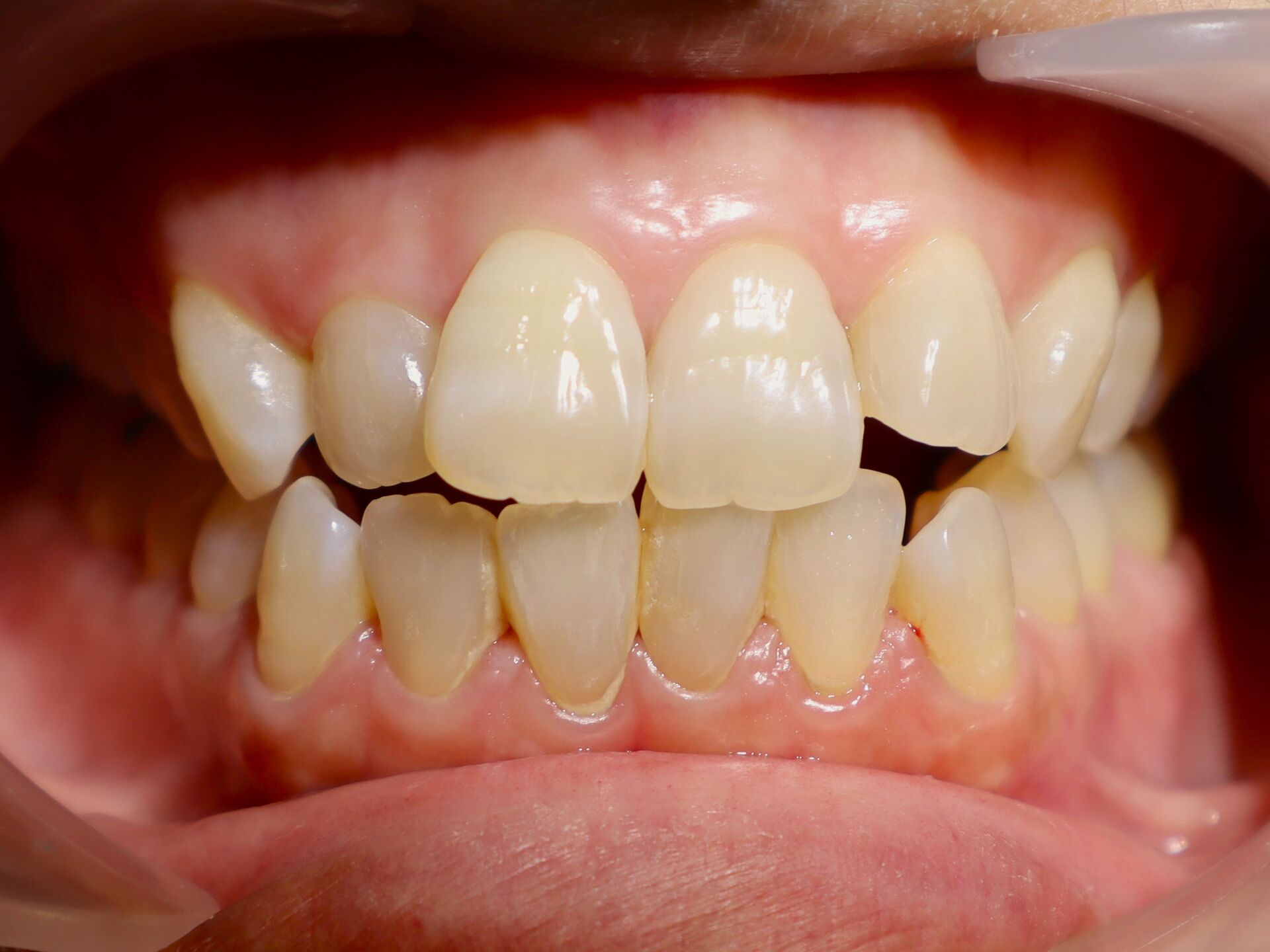 fuchu-invisalign-case3-before1