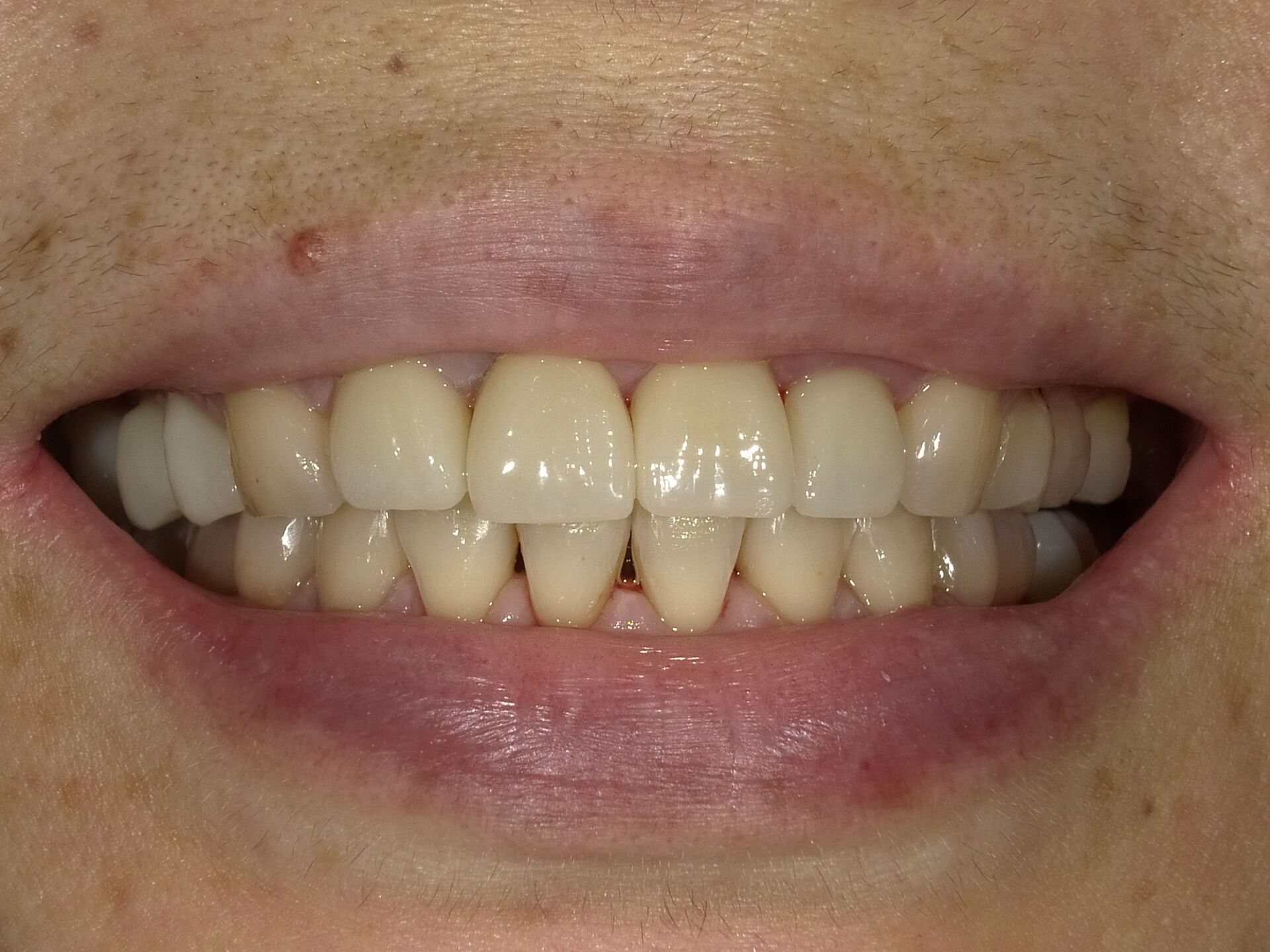 fuchu-invisalign-case4-after2